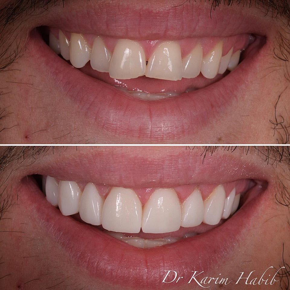 Veneers without braces