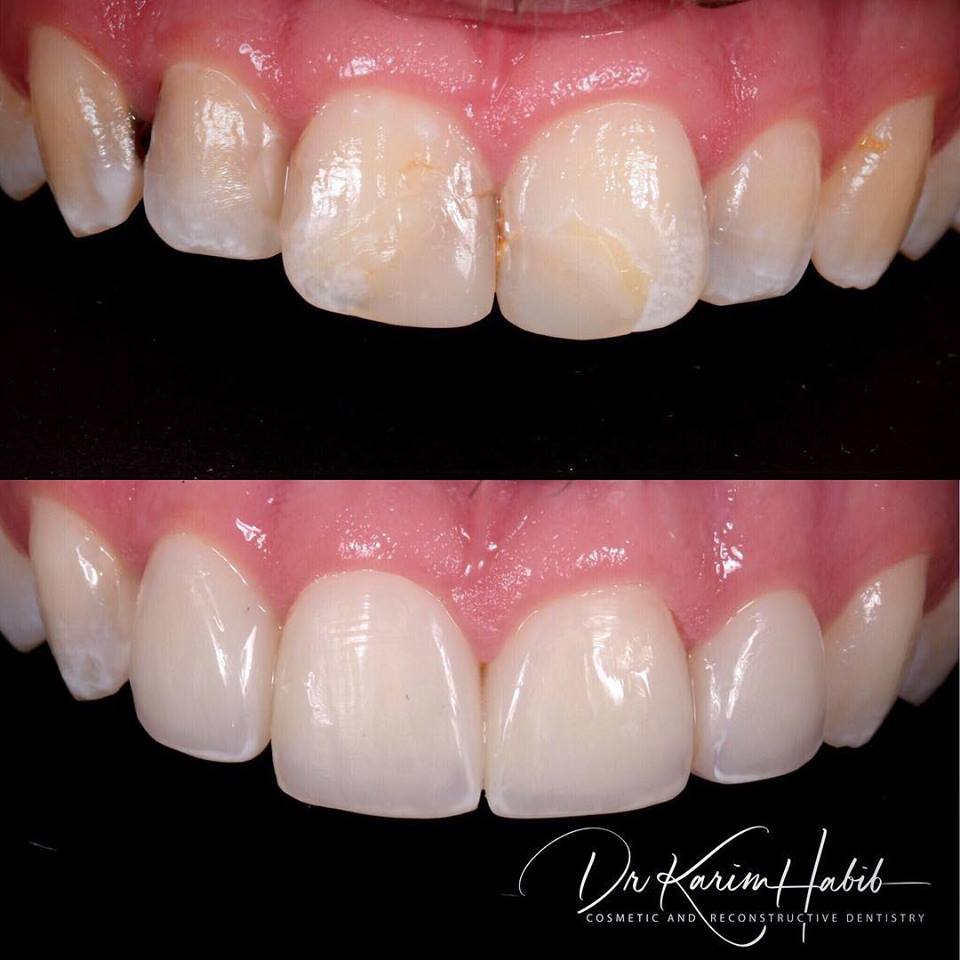 Natural looking veneers in Sydney