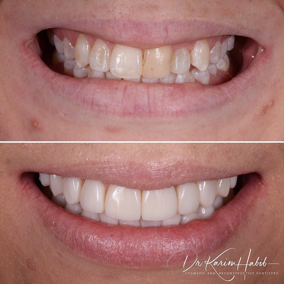 Composite veneers Sydney Smile makeover