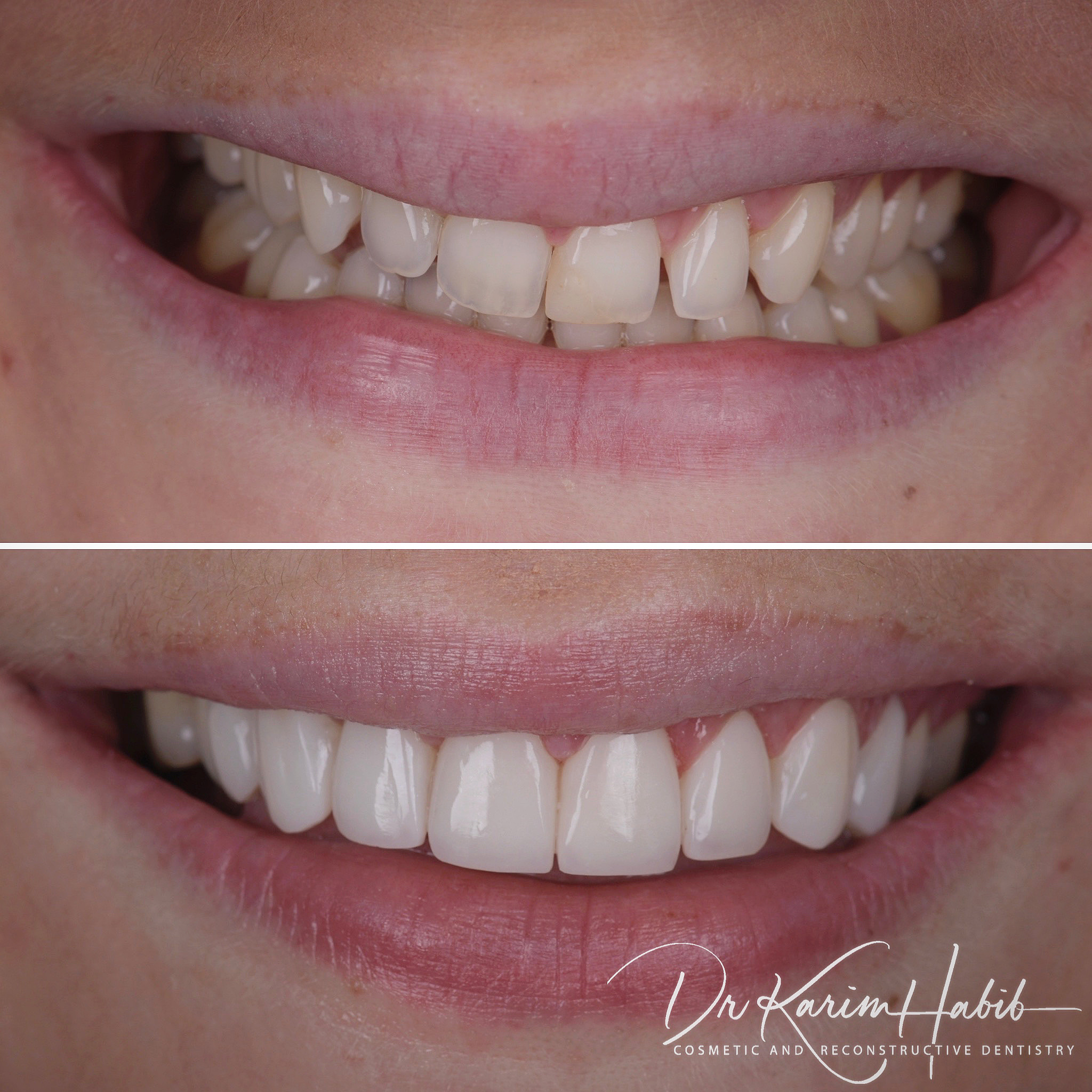 Composite Veneers Smile