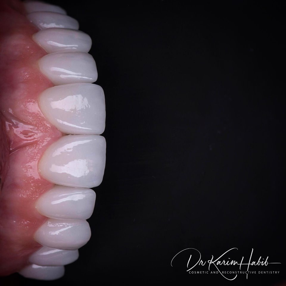 Porcelain Veneers by Sydney Cosmetic Dentist, Dr Karim Habib