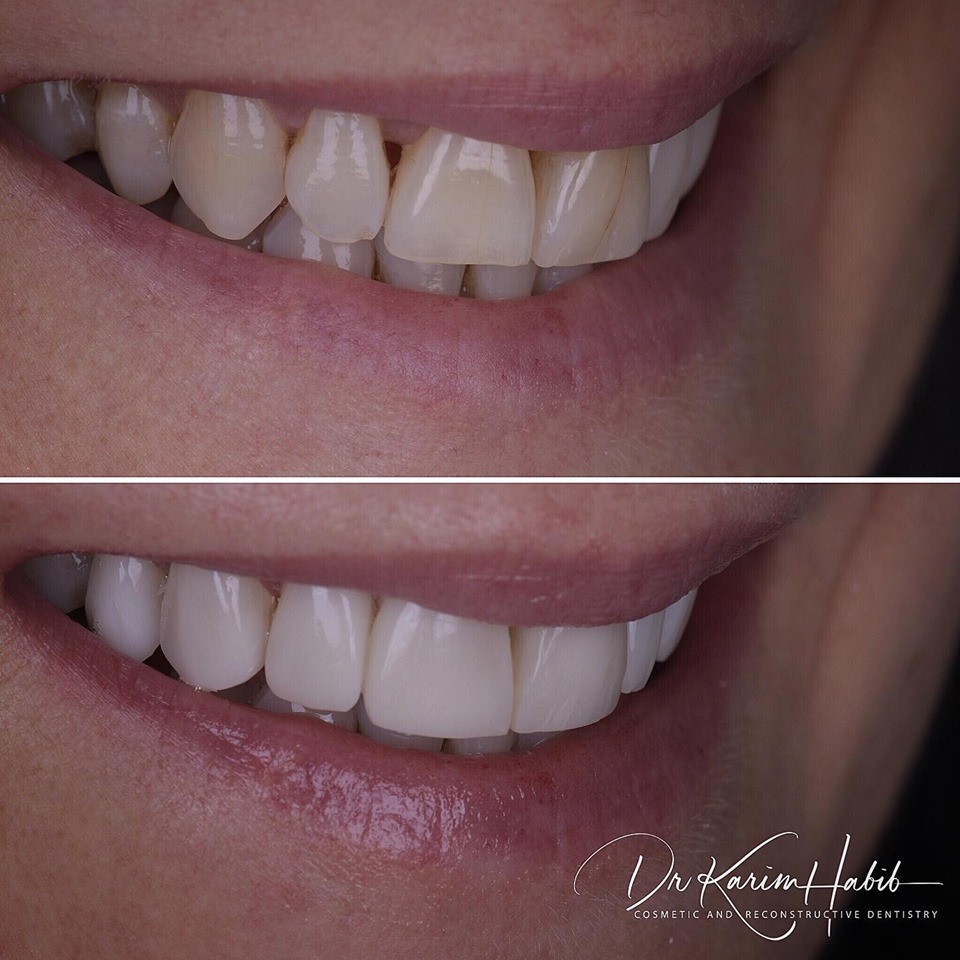 Anti aging veneers by Dr K
