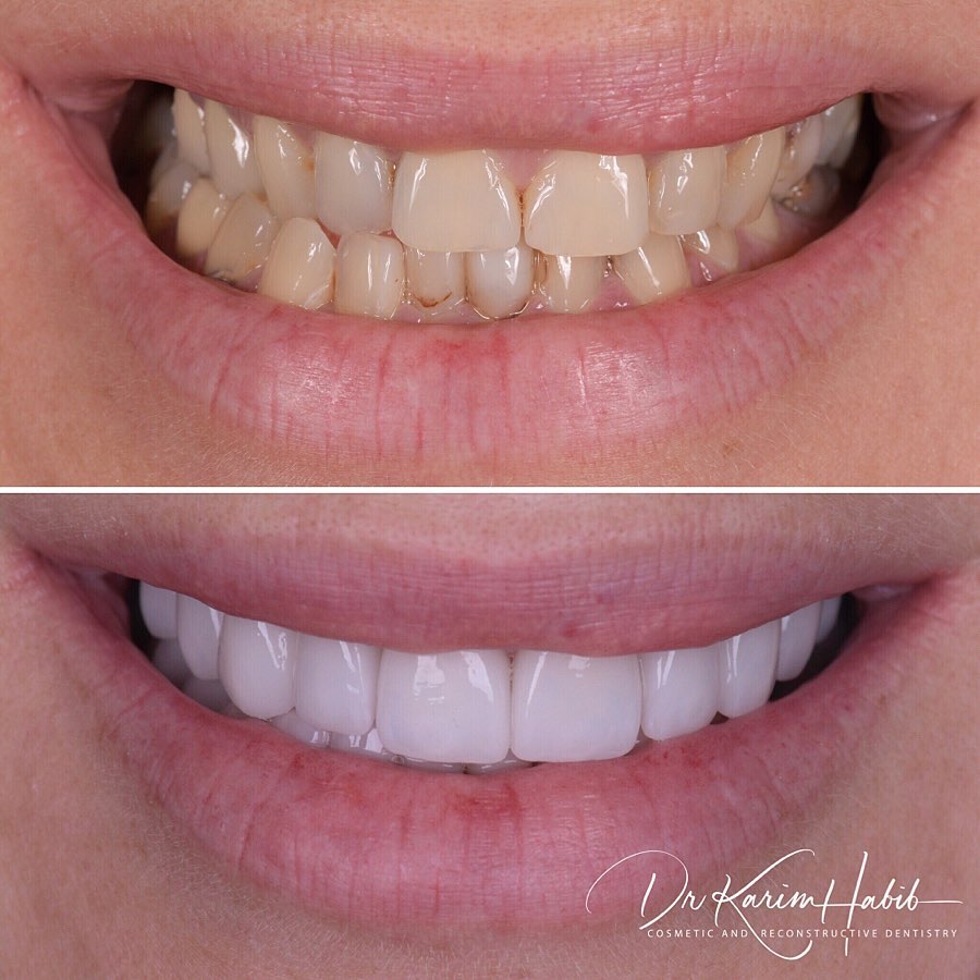 Porcelain Veneers Cosmetic Dentist Smile Makeover