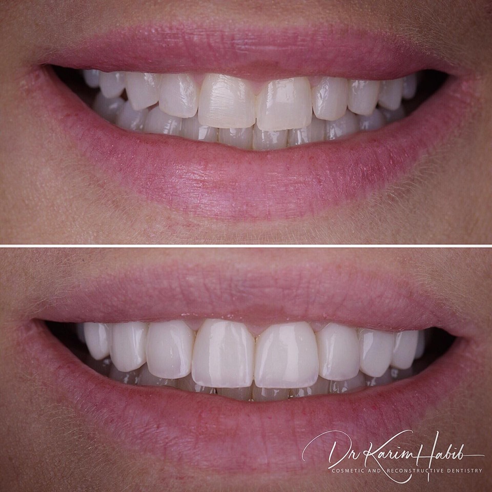 Best Composite Veneers dentist in Sydney