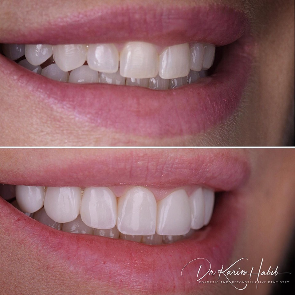 Direct Resin Veneers Sydney