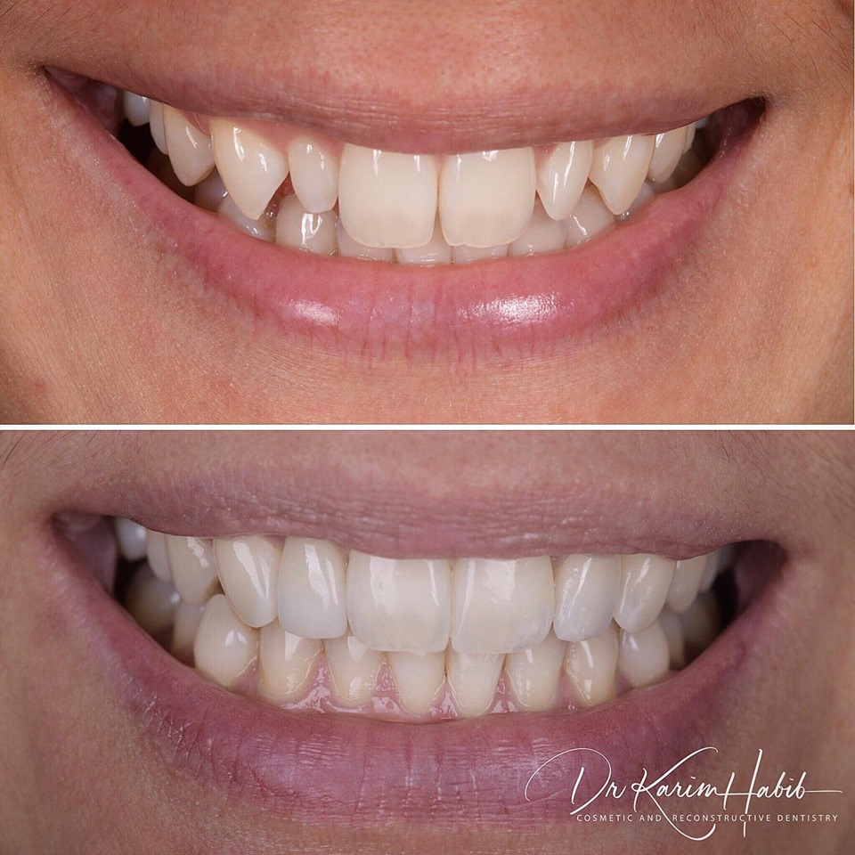 Invisalign, gum contouring, porcelain veneers and composite bonding