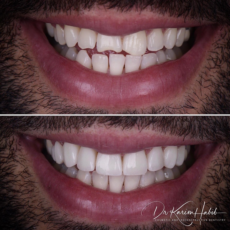 Composite Veneers Sydney