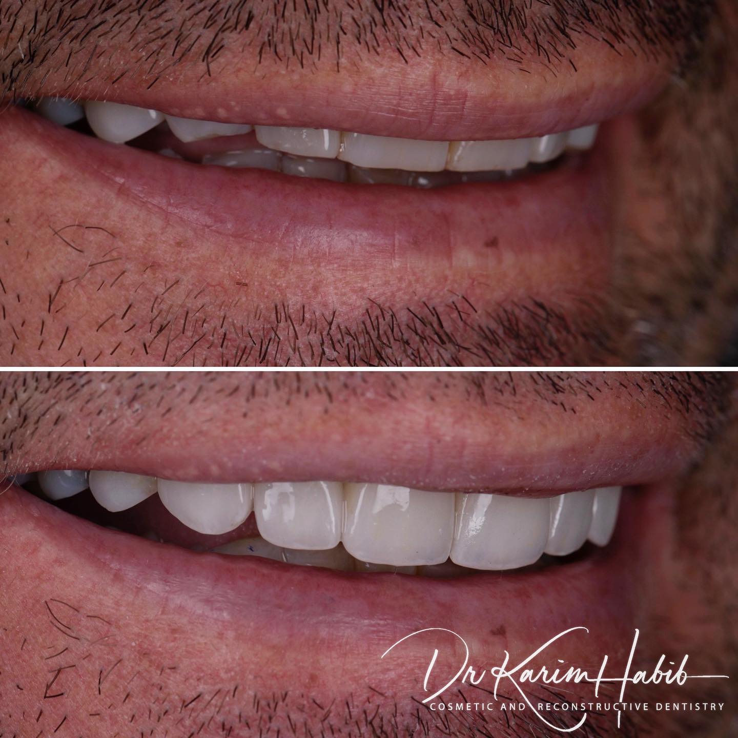 Porcelain Veneers Sydney