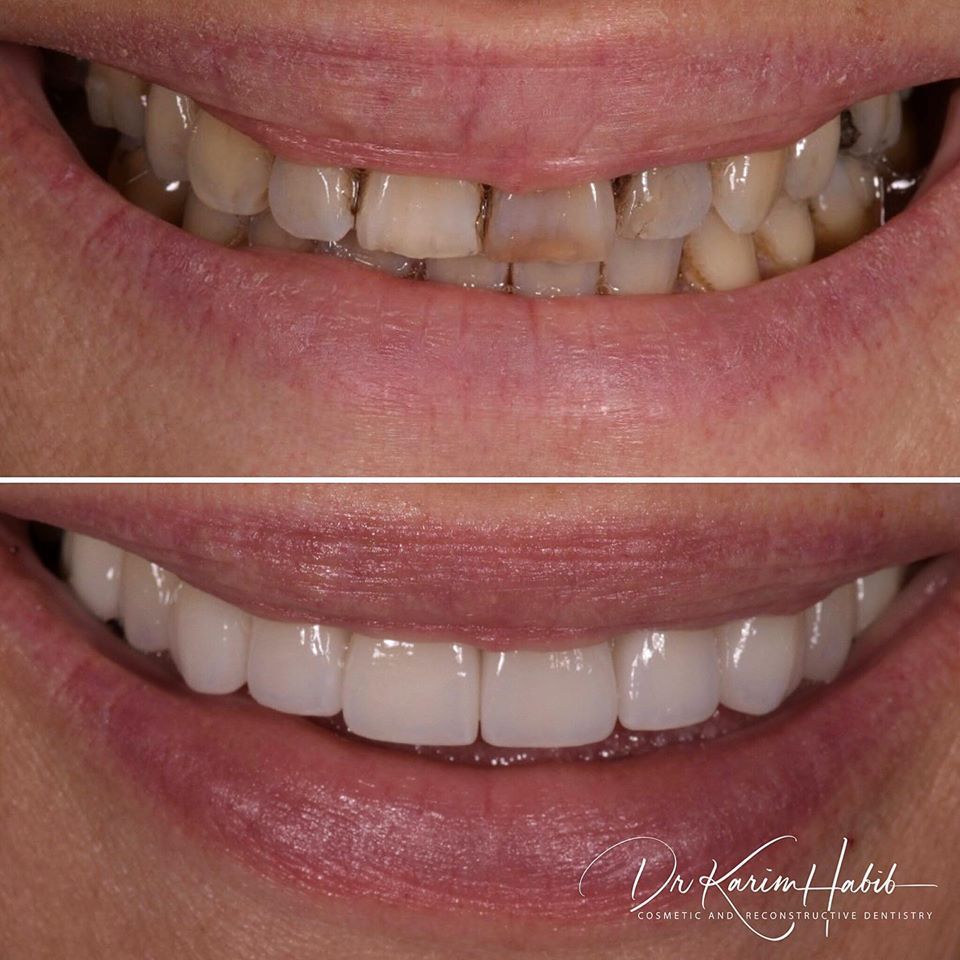 Complete Smile Makeover Australia