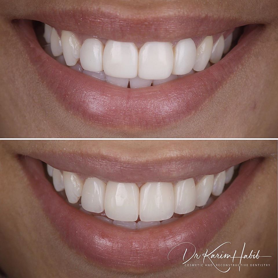 Natural Composite Veneers