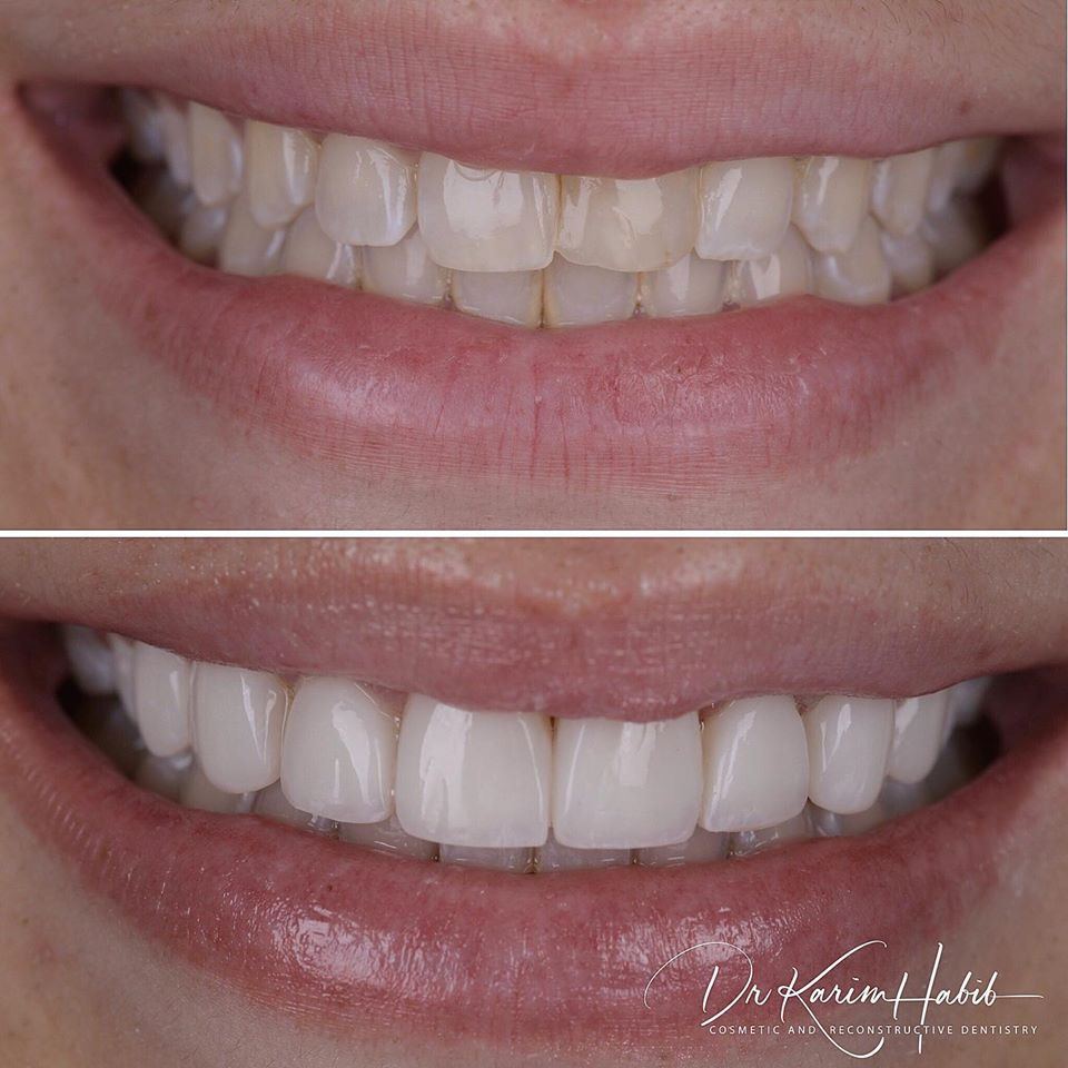 Ultra Natural composite veneers