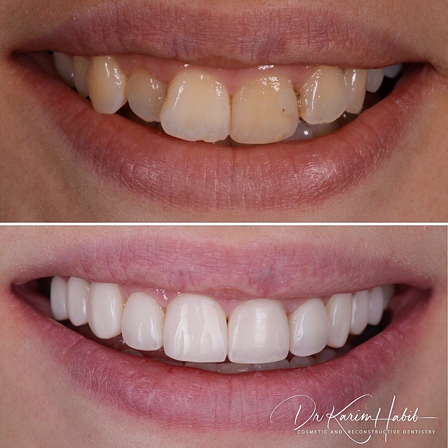 Invisalign crowded teeth and Veneers