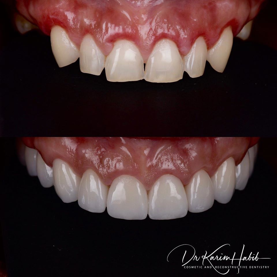 High Quality Porcelain Restorations