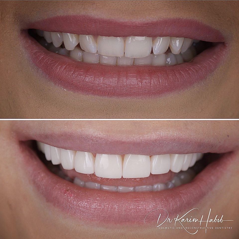 Hollywood Veneers