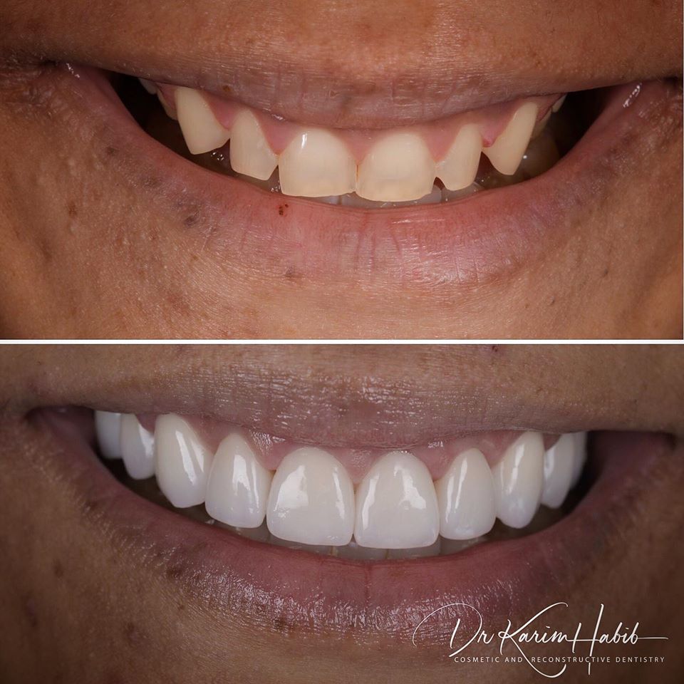 Full upper arch smile makeover