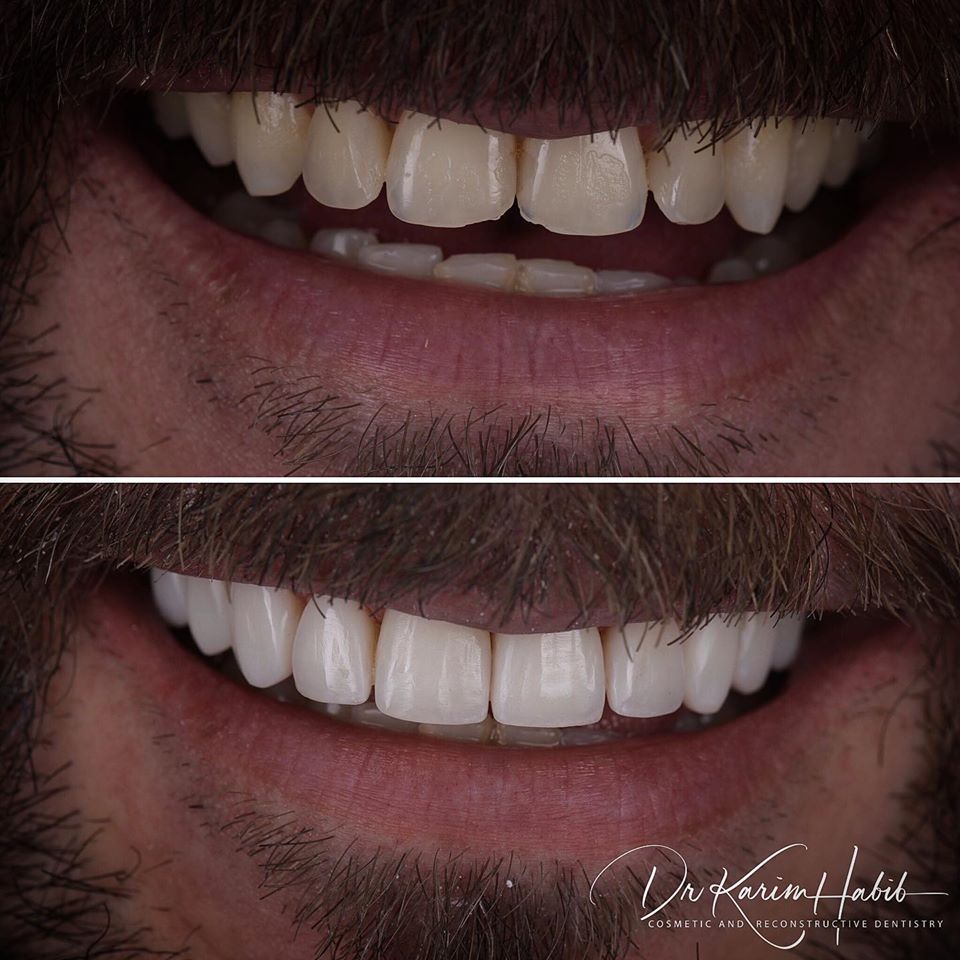 Composite Veneers - Single Visit