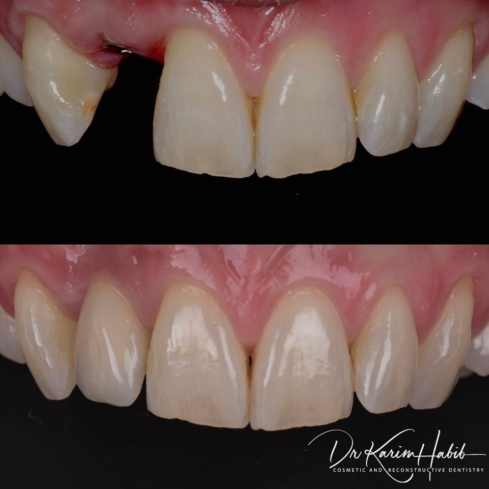 Dental Implant sydney