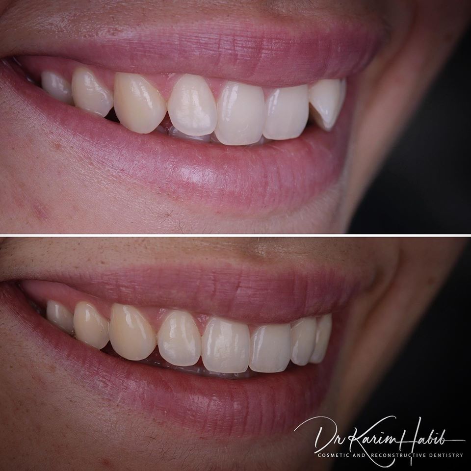 Invisalign Sydney, Invisible Braces Sydney