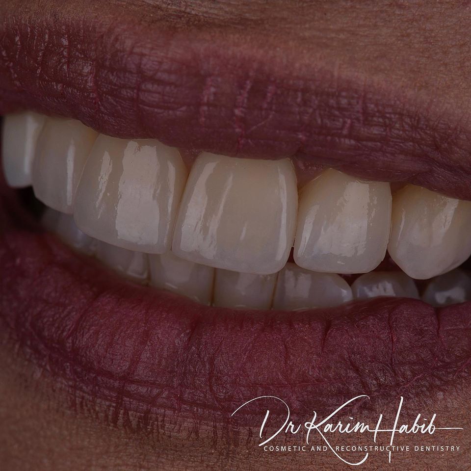 Close up Quality Sydney Porcelain Veneers