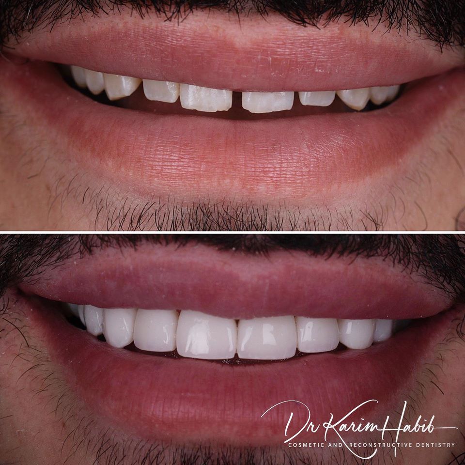 Composite veneers sydney by Dr Karim Habib