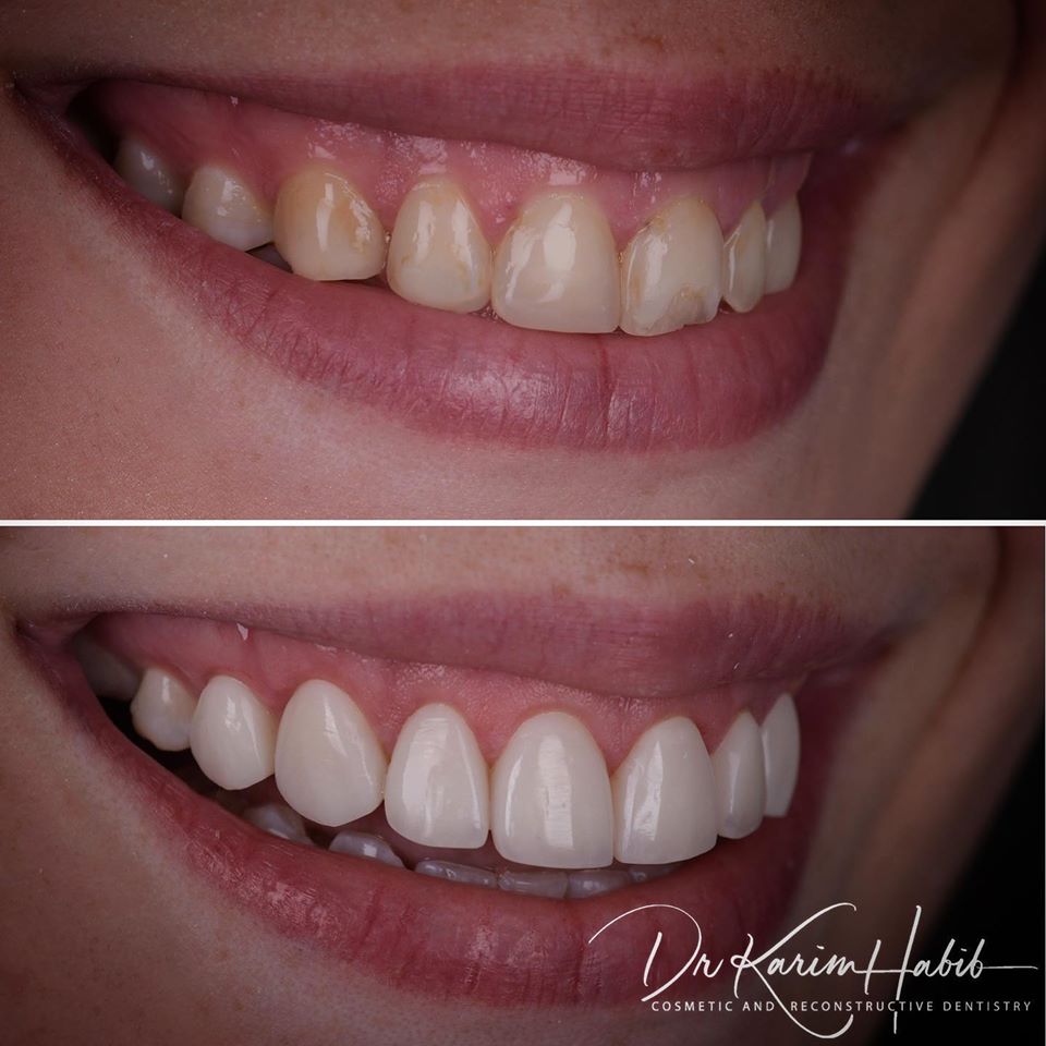 Best composite veneers in Australia