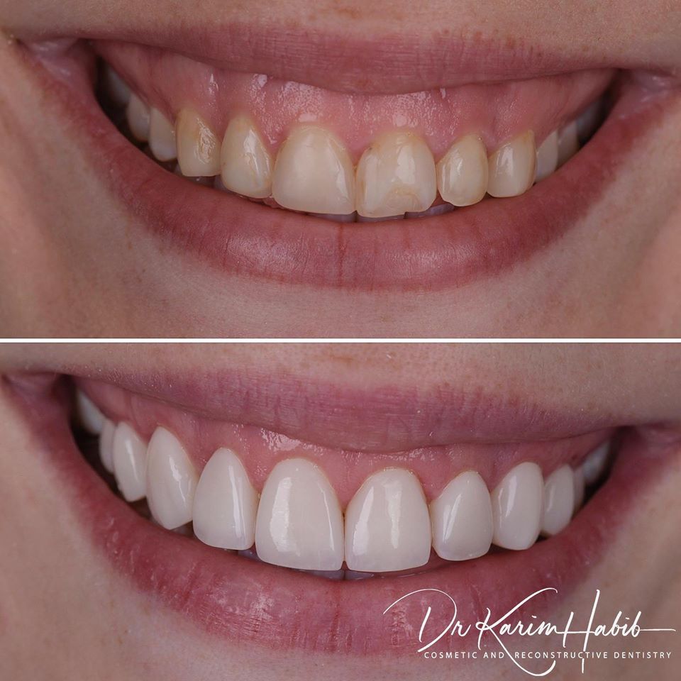 Sydney Composite Veneers