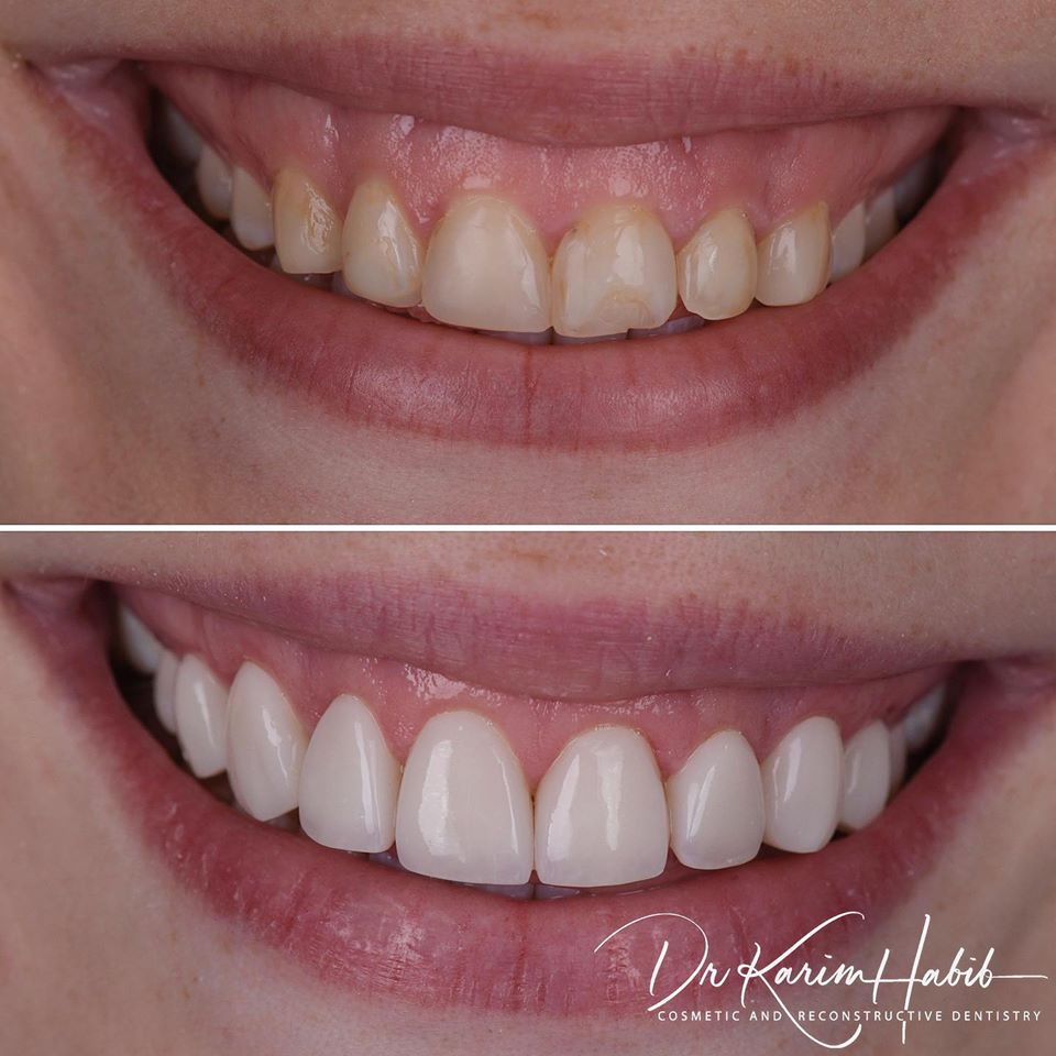 Sydney Composite Veneers 