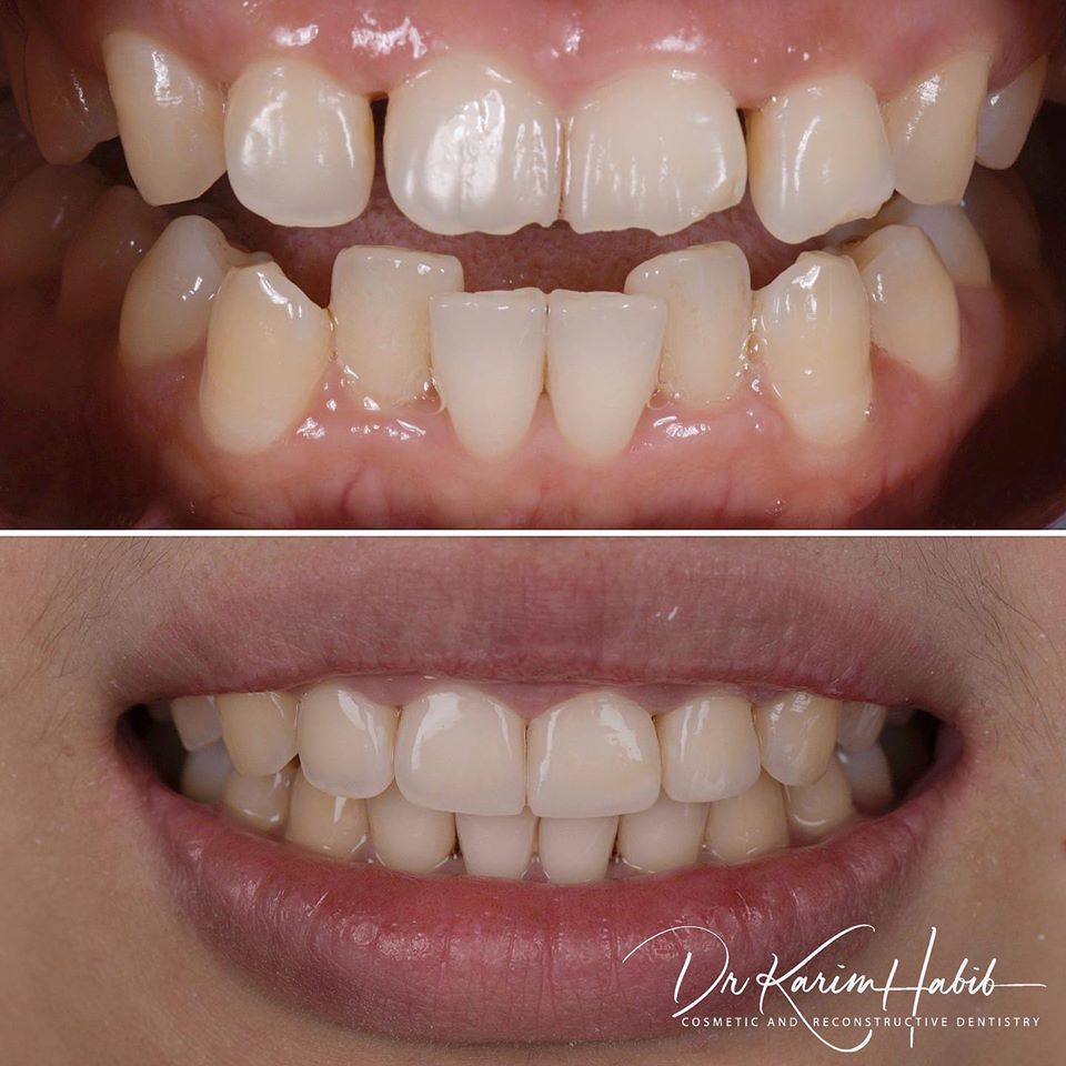 Invisalign Sydney, Invisible Braces Sydney