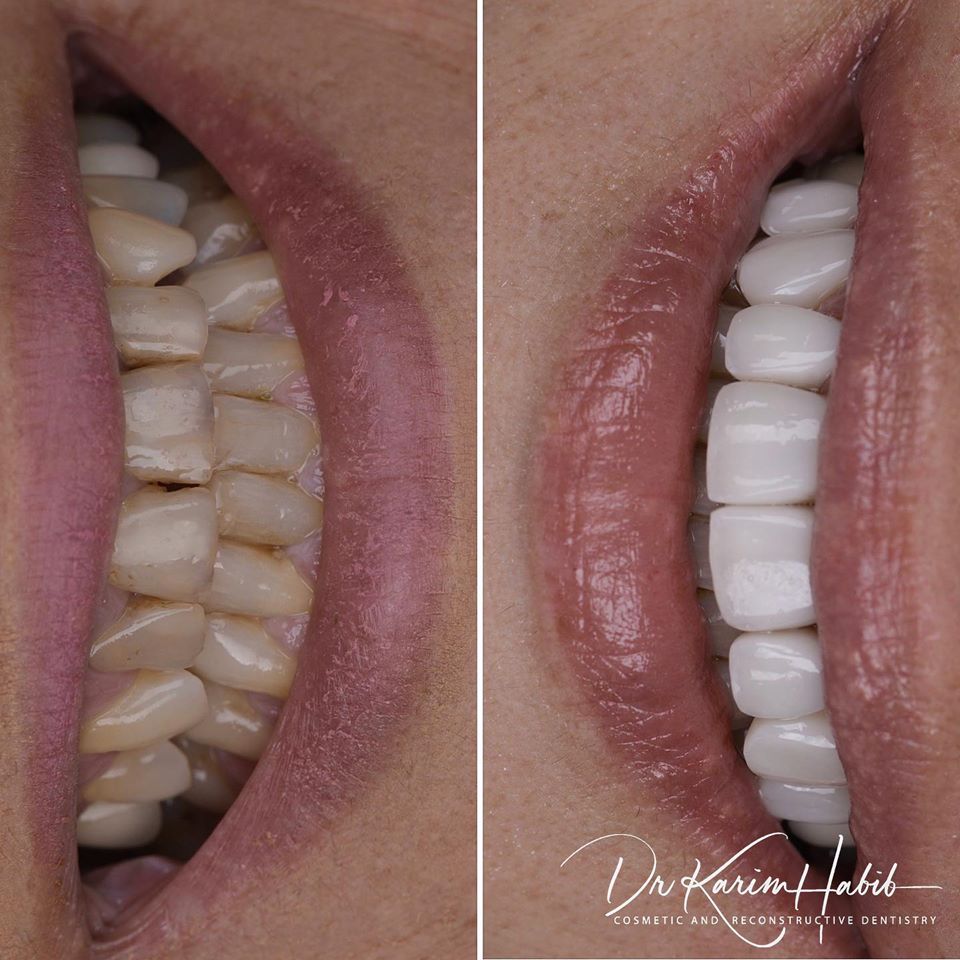 Ultra Natural Composite Veneers