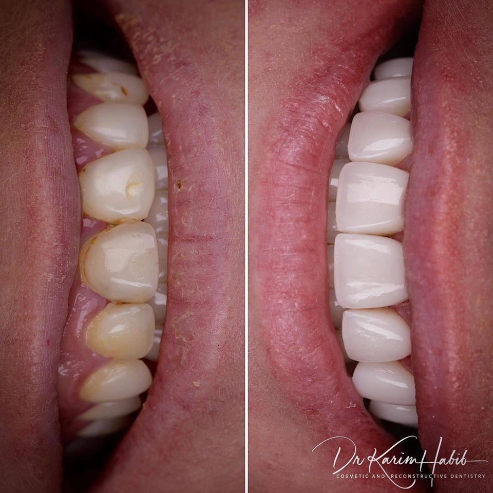 Composite Veneers Australia