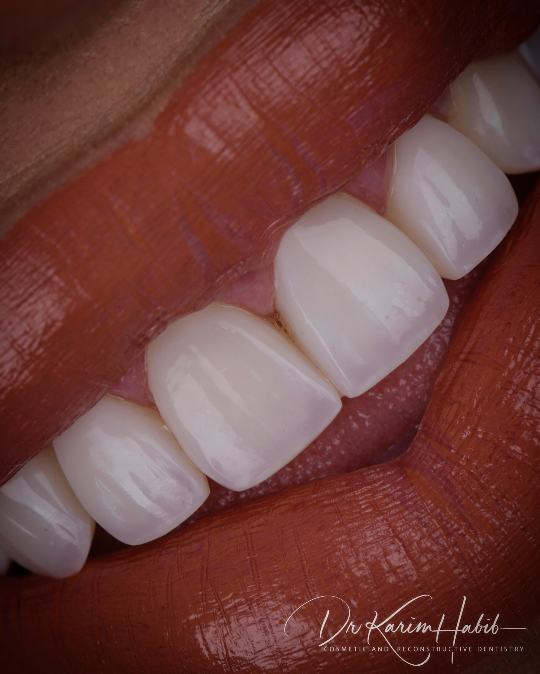 Composite Veneers Sydney Cosmetic Dentist
