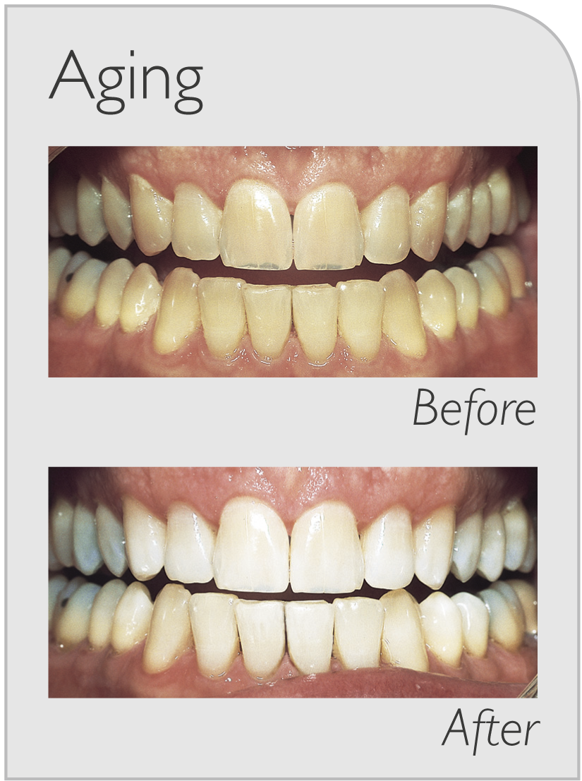 dental teeth whitening in ryde