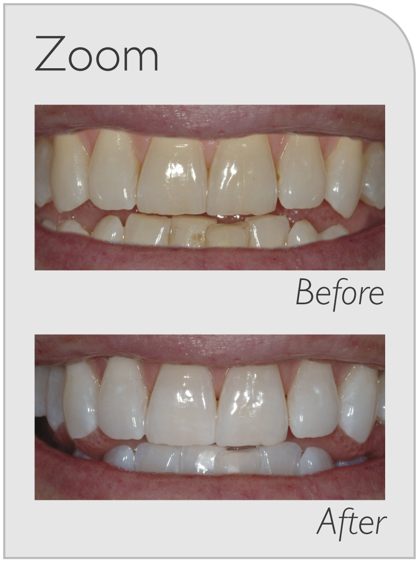 teeth whitening ryde
