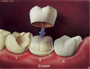 Crowns