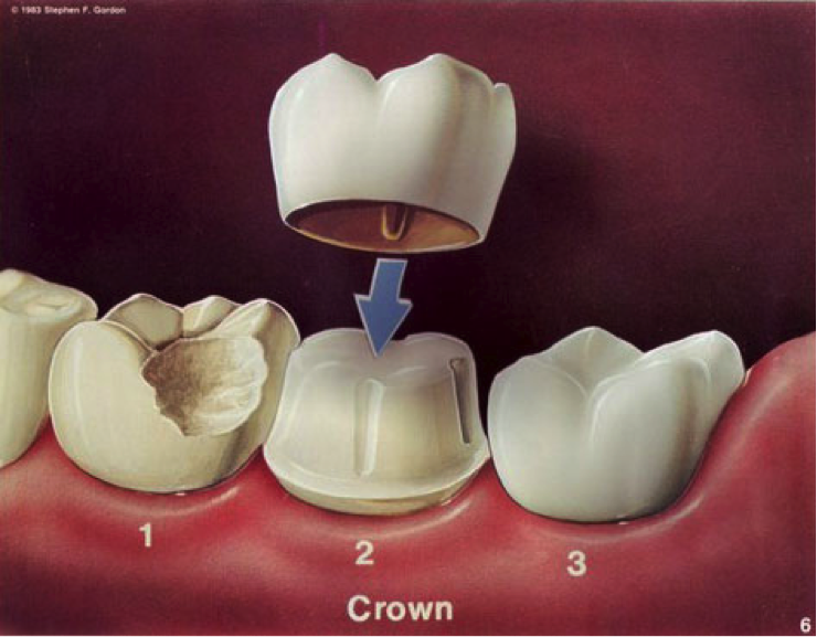 Dental Crowns and Bridges in Sydney - Quality Teeth Caps Treatment