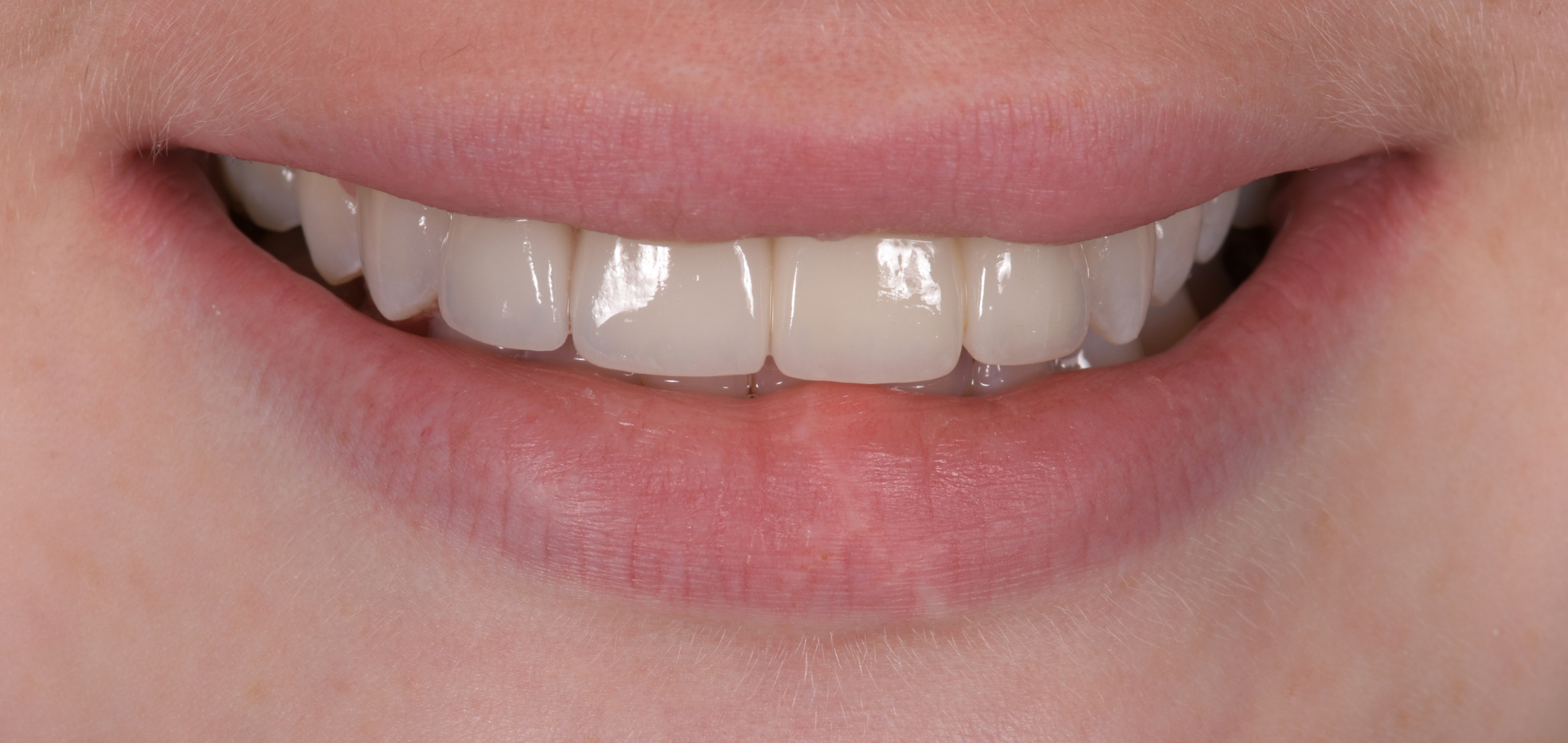 Cosmetic Smile Makeover
