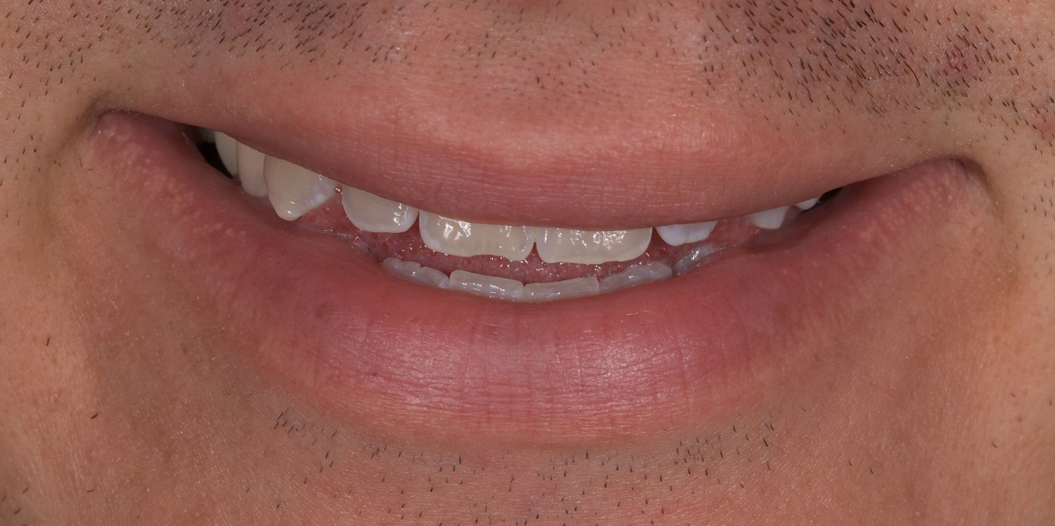 Before porcelain veneers