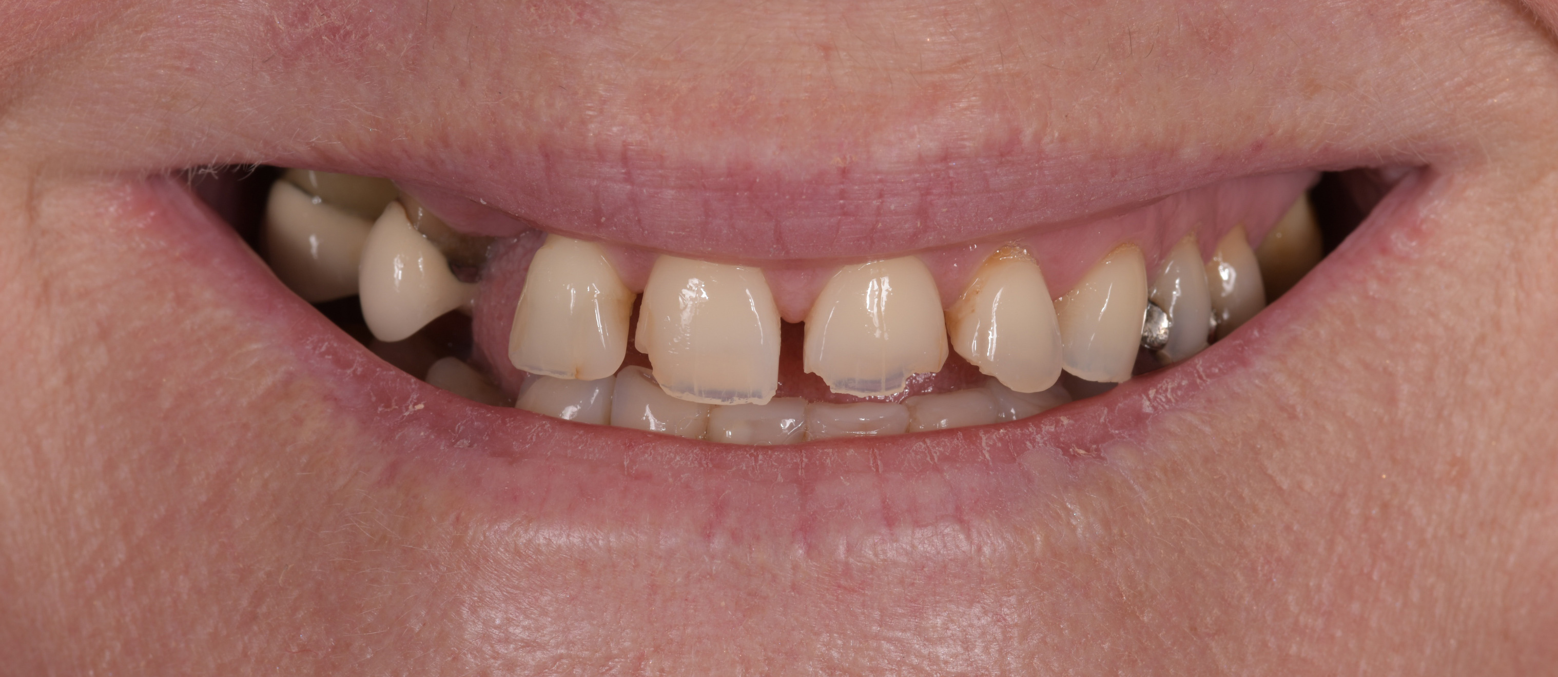 Worn down teeth to be fixed with dental crowns