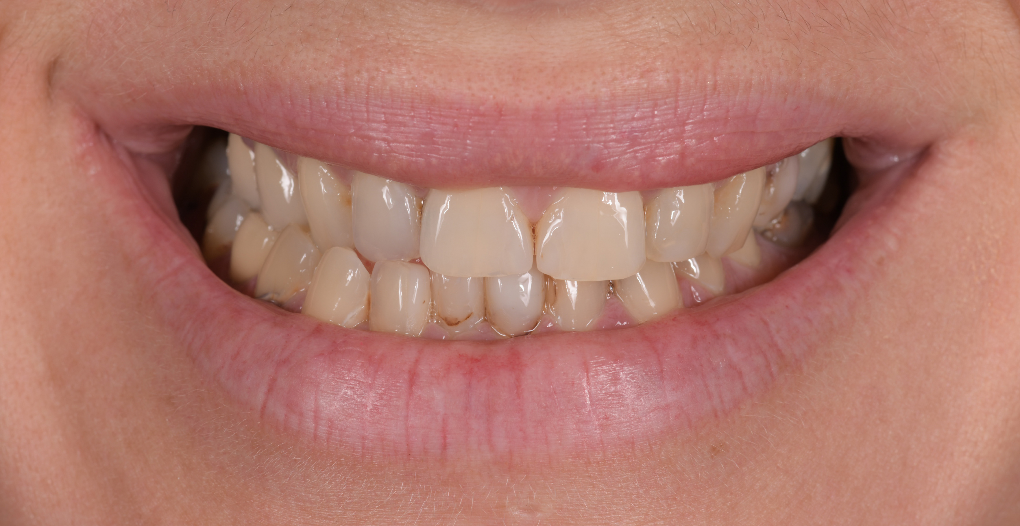 Complete Smile Makeover Teeth Sydney