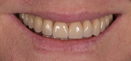 Porcelain crowns and veneers Sydney