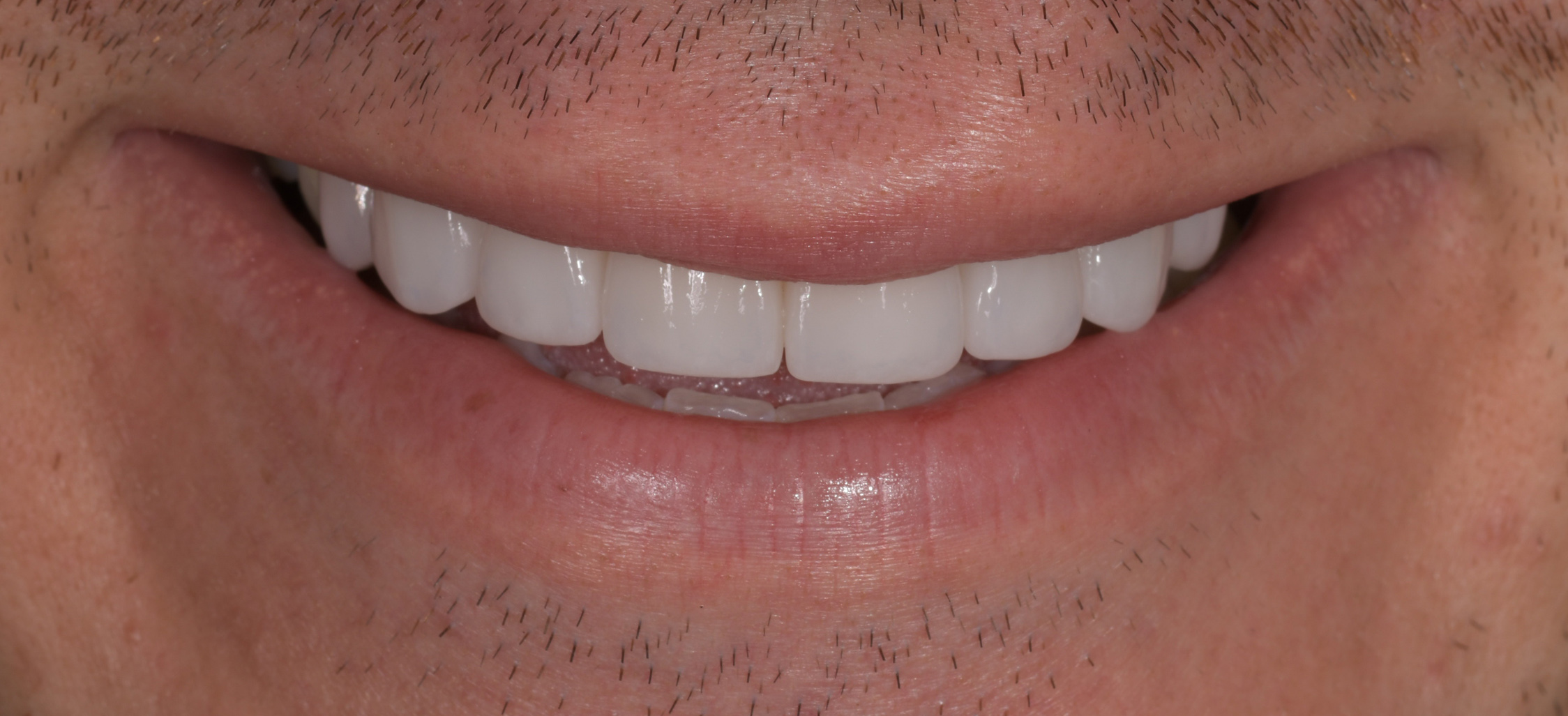 New smile with Porcelain Veneers in Sydney