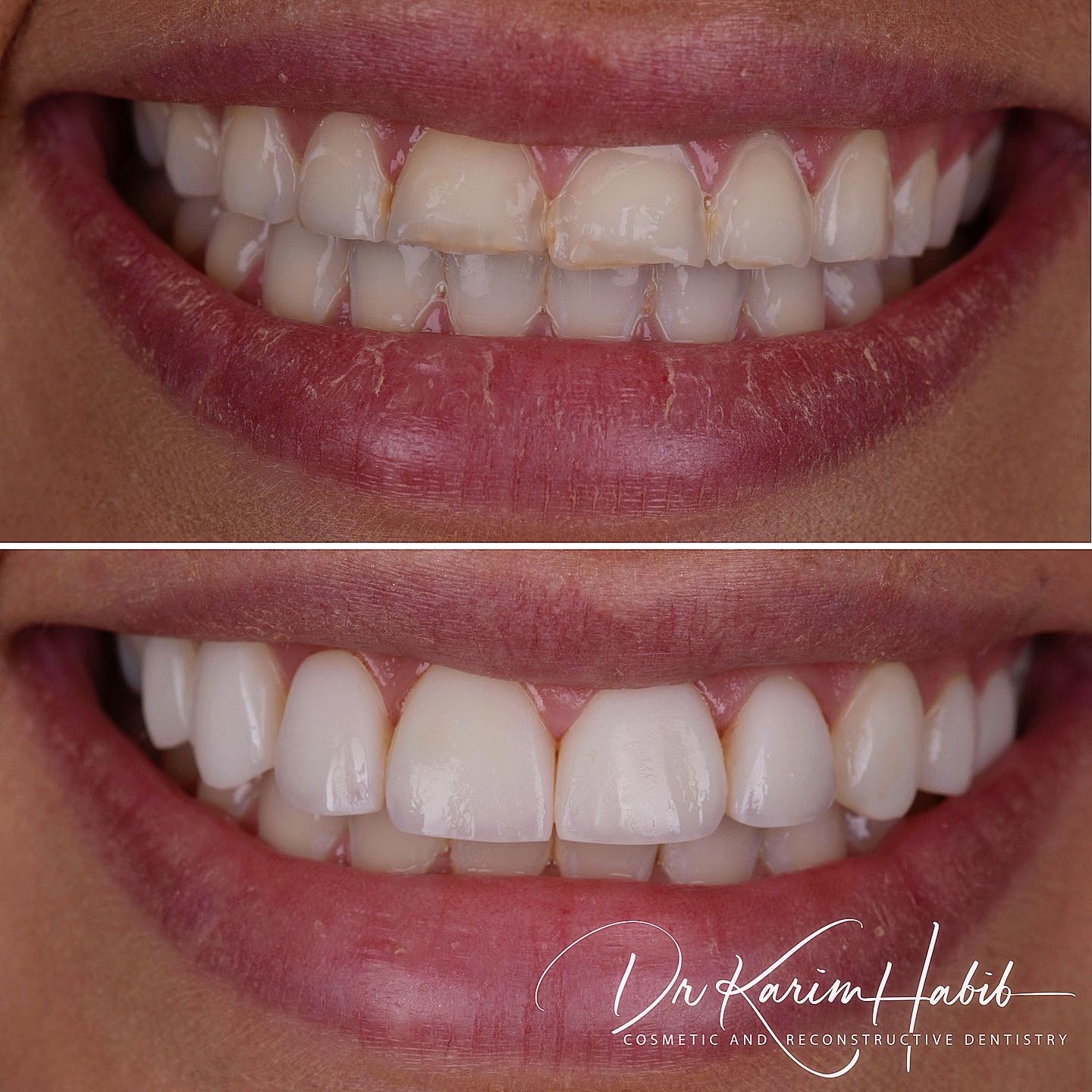 Best Composite Veneers