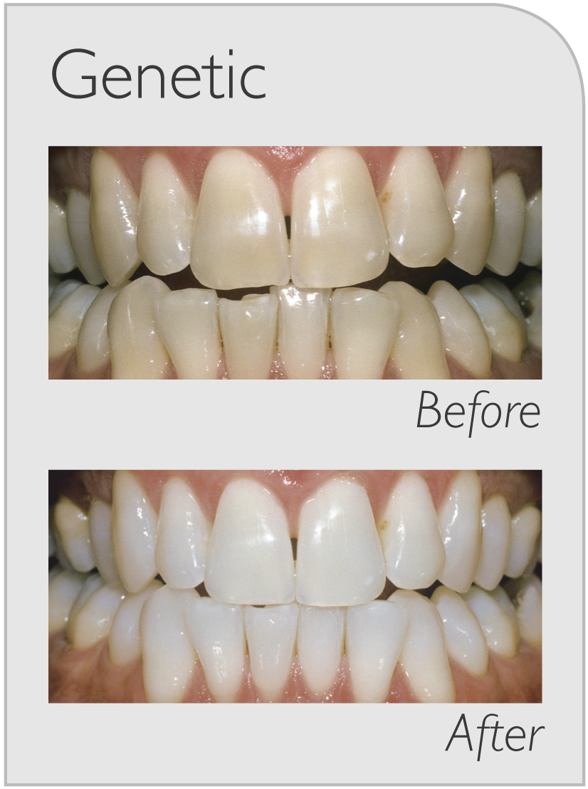 professional teeth whitening ryde