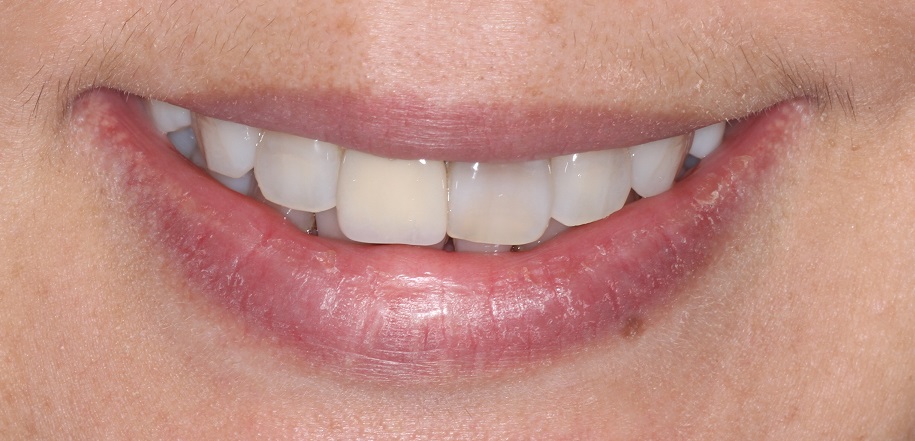 Before Cosmetic Dentistry Sydney