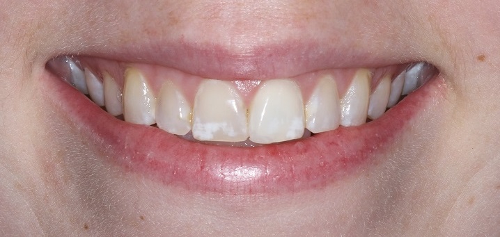 Teeth can be repaired cosmetically with Porcelain Veneers
