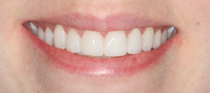 Most Natural Porcelain Veneers in Sydney