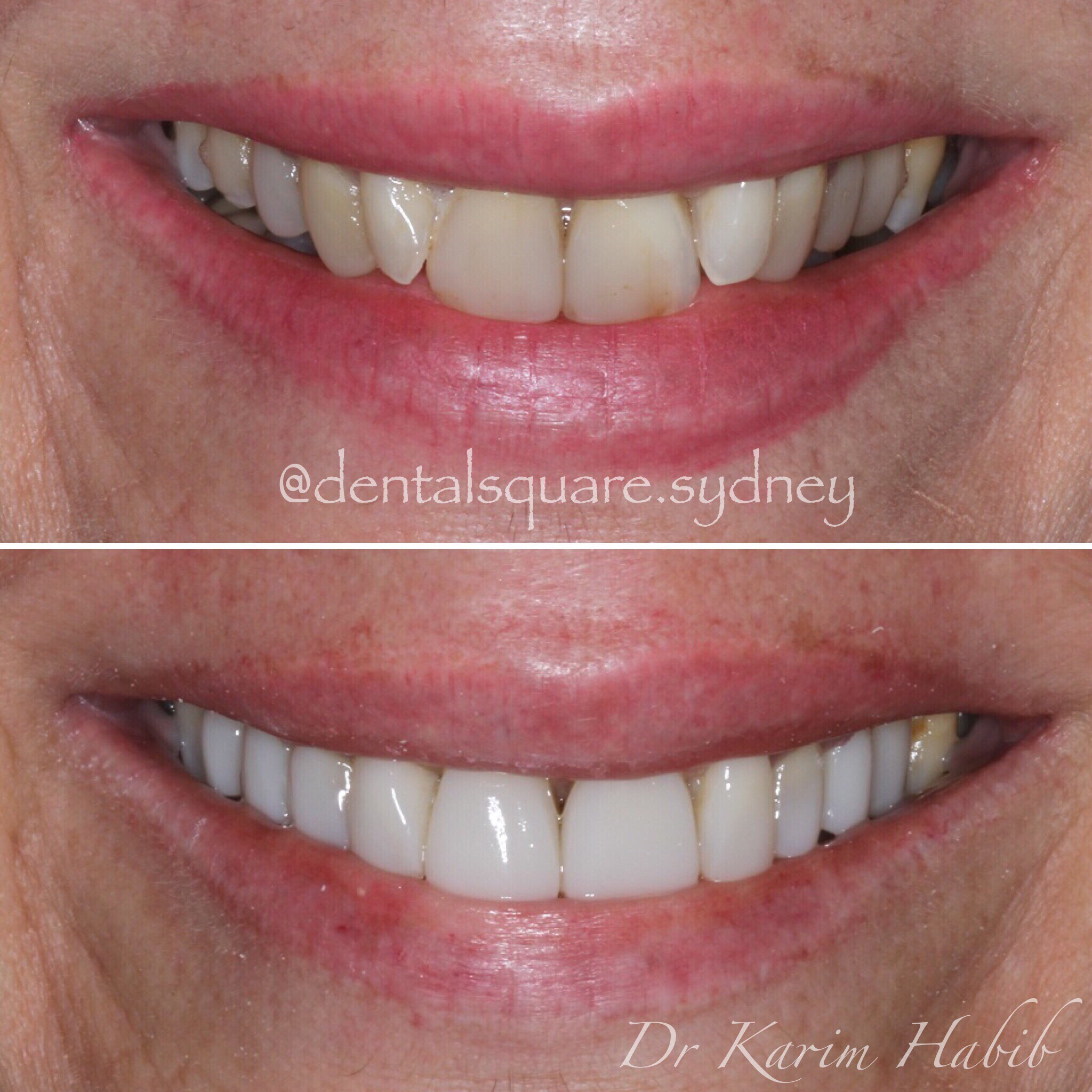 Best Composite Veneers sydney