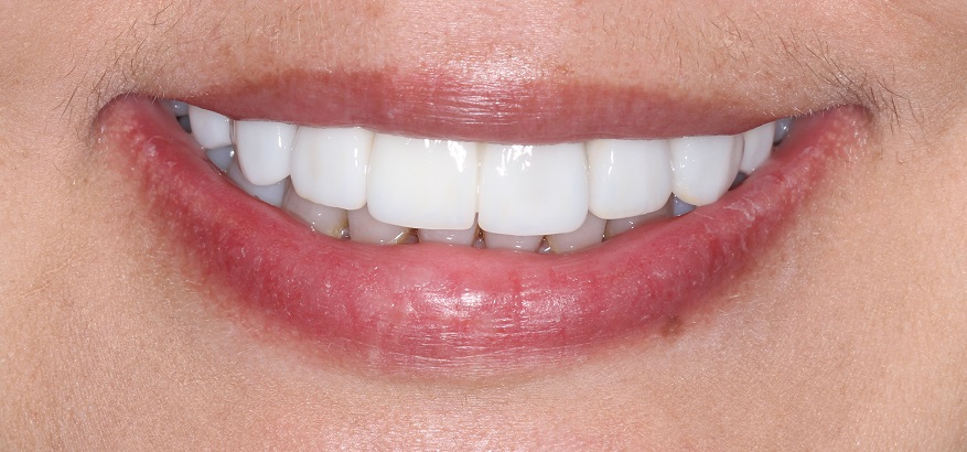 Dental Veneers Sydney Dr Karim Habib