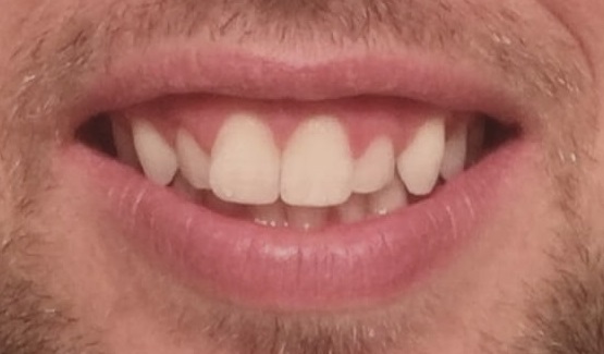 Before Gummy smile treatment and porcelain veneers