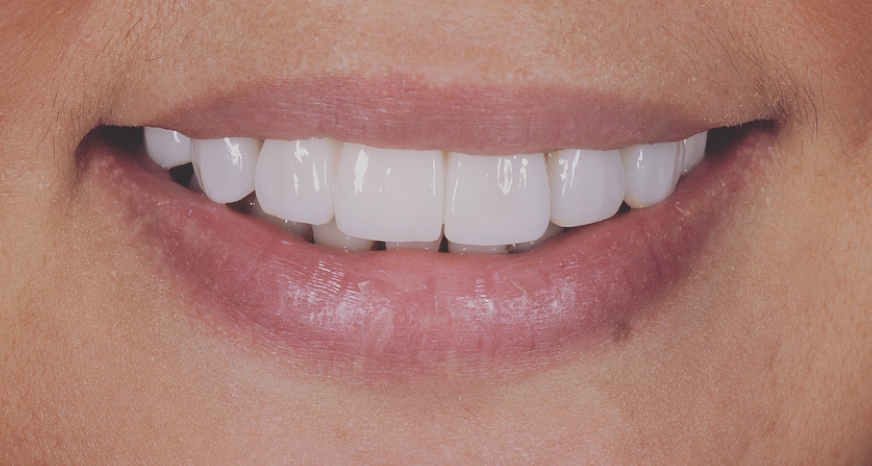 Smile Makeover in sydney Cosmetic Dentist Dr Karim Habib